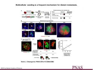 Multicellular seeding is a frequent mechanism for distant metastasis. (A) Schema of multicolor lineage tracing assay. ROSAmT/mG;MMTV-PyMT tumor organoids were treated with adenoviral Cre to induce recombination from membrane tdTomato (mTomato) to membrane eGFP (mGFP). Mosaic tumor organoids were then transplanted into nonfluorescent NSG host mice. After 6–8 wk, lungs of these mice were harvested. If metastases arise exclusively from single-cell seeding, there should be only single color metastases. In contrast, multicellular seeding should produce metastases with both colors. (B) Representative micrographs of polyclonal lung metastases of different sizes. n = 355 polyclonal metastases, across 16 mice and 4 independent experiments. (C) Representative micrograph of a mosaic tumor organoid treated with adeno-Cre and grown in 3D Matrigel with intermixing of red and green tumor cell clones. (D and E) Representative micrographs of primary tumors arising from mosaic tumor organoids transplanted into NSG host mice. Primary tumors varied in their local mixing of red and green tumor cell clones (local mixing %). These differences correlated with the percentage of multicolored metastases detected in the lung (% multicolored). n = 12 mice, 4 independent experiments, 4,072 metastases. Correlation determined by Spearman rank test for samples with more than five lung metastases per mouse. (Scale bars, 20 μm in B and C, and 2 mm in D.)‏ 